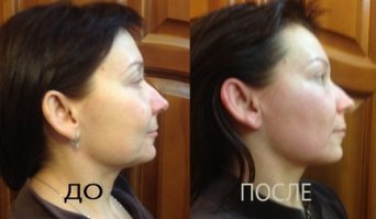 БМС лица по методу Н.Осьмининой 1 сеанс БМС лица москва